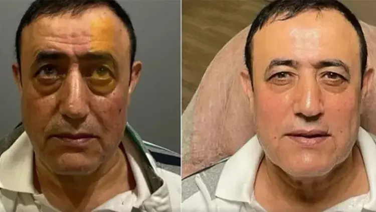 Mahmut Tuncer'in estetik değişimi olay yarattı - Resim : 1