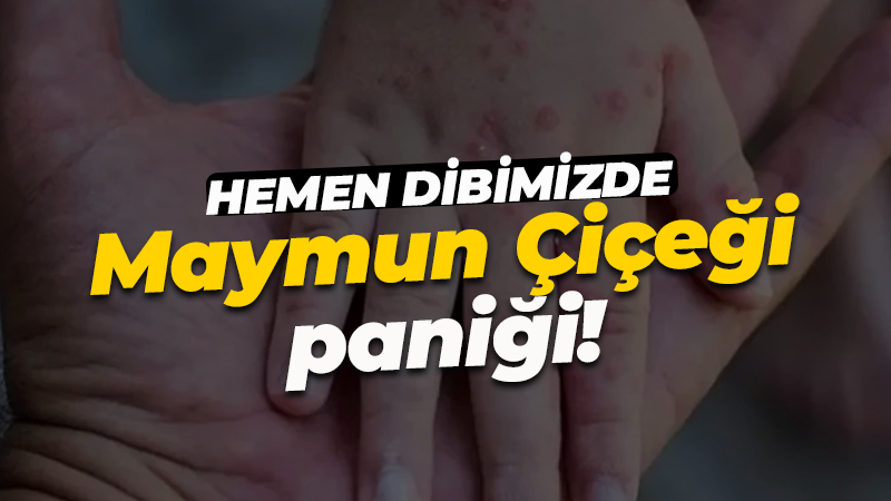 Hemen dibinizde: Maymun çiçeği paniği! Karantinaya alındı